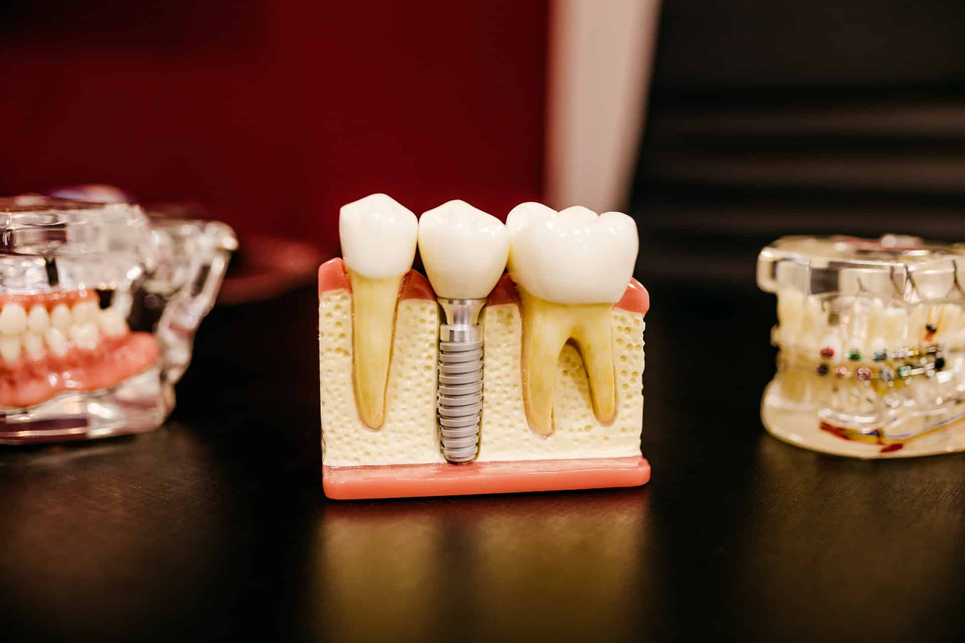 Effective Care Tips for Dental Implants
